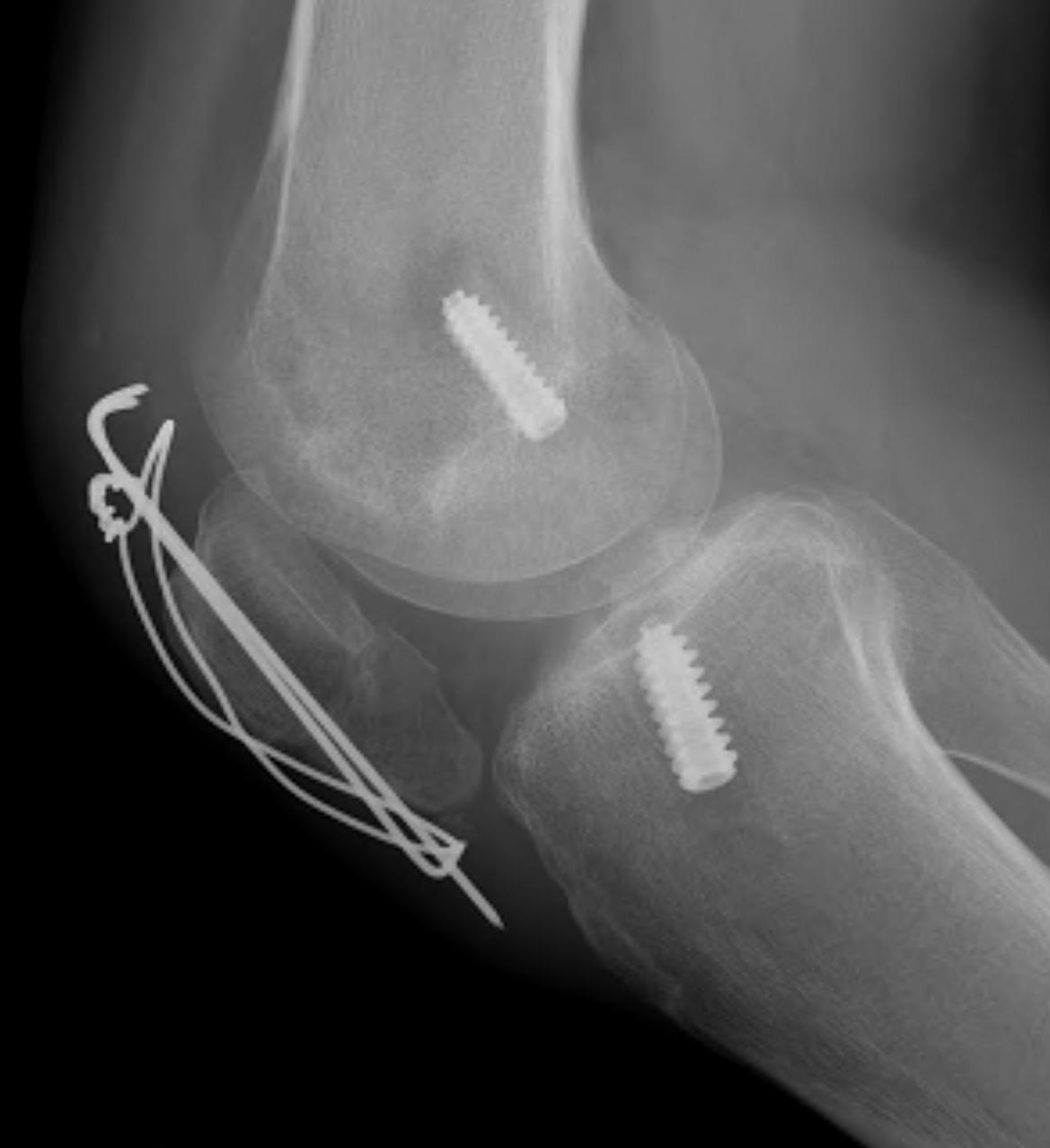 ACL BPTB Patella ORiF Lateral